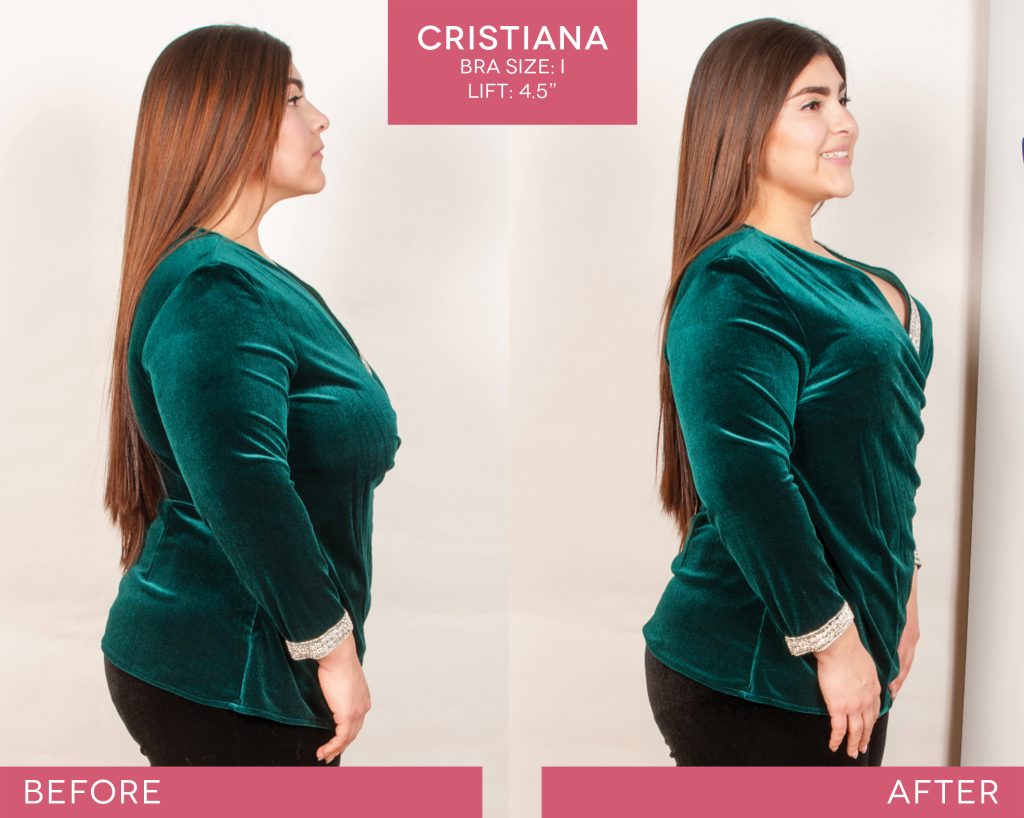 BralessBra-Cristiana_Before-After-1